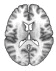 Structural MRI